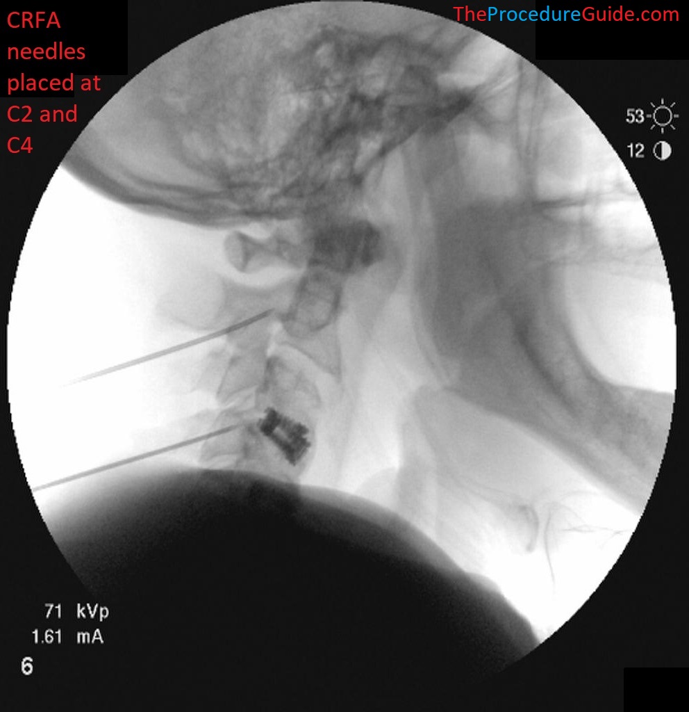 Cervical spine x ray cpt feetjd