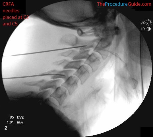 Lateral Fluoroscopy cervical radiofrequency ablation needle placement C2 and C5