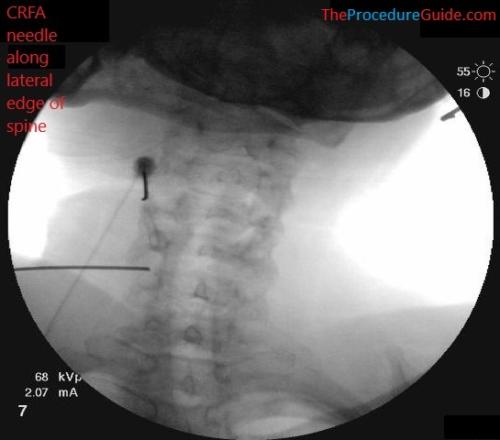 AP Fluoroscopy cervical radiofrequency ablation needle placement