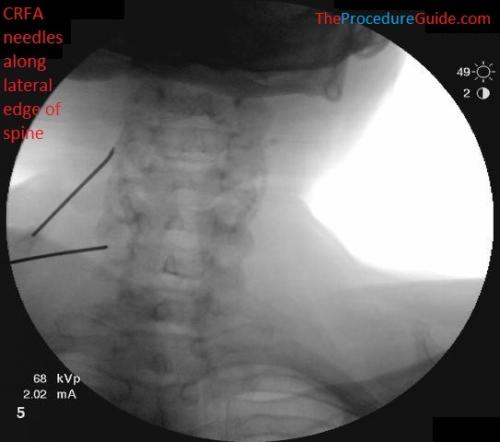 AP Fluoroscopy cervical radiofrequency ablation needle placement