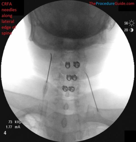 AP Fluoroscopy cervical radiofrequency ablation needle placement