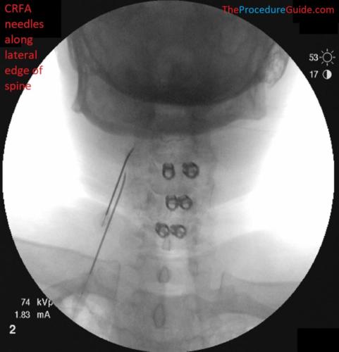 AP Fluoroscopy cervical radiofrequency ablation needle placement