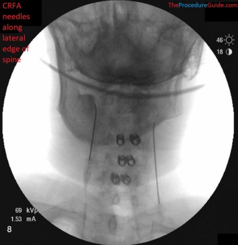 AP Fluoroscopy cervical radiofrequency ablation needle placement