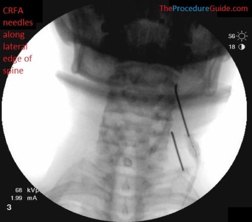 AP Fluoroscopy cervical radiofrequency ablation needle placement