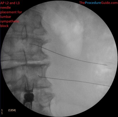 AP fluoroscopy lumbar sympathetic block at L2 and L3