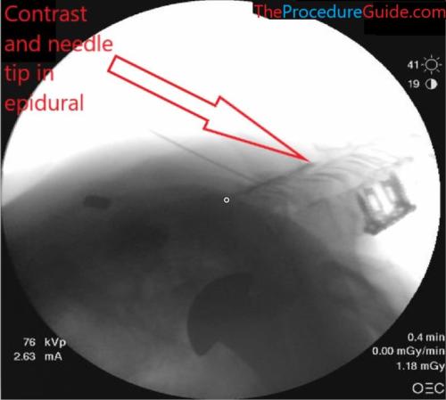 cervical epidural steroid injection fluoroscopy lateral