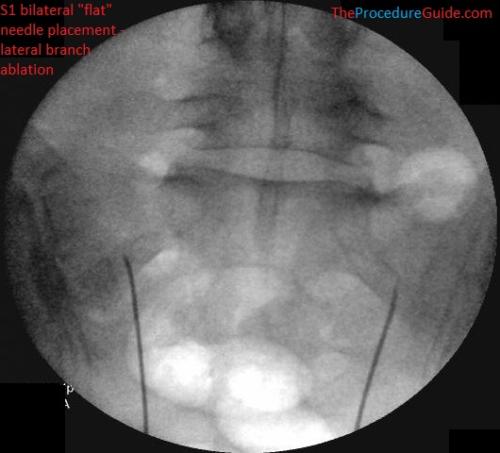 Fluoroscopic Guided Sacroiliac Joint dorsal ramus and lateral branch radiofrequency ablation - AP S1 bilateral needle placement