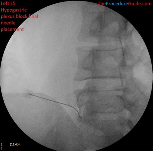 Hypogastric Plexus Block AP and Oblique fluoroscopy