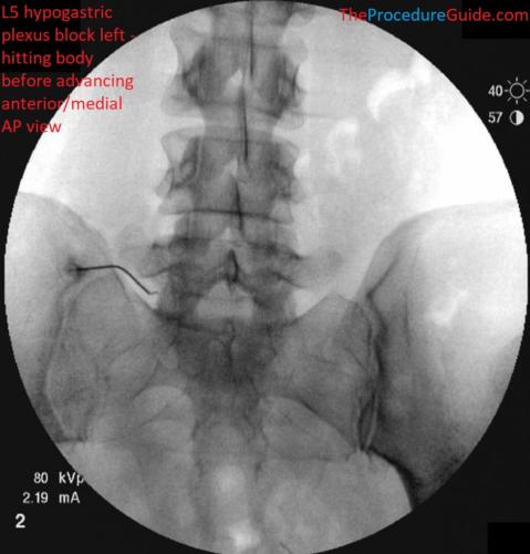 Hypogastric Plexus Block AP and Oblique fluoroscopy