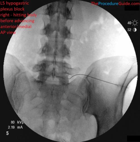 Hypogastric Plexus Block AP and Oblique fluoroscopy