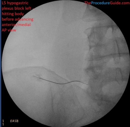 Hypogastric Plexus Block AP and Oblique fluoroscopy