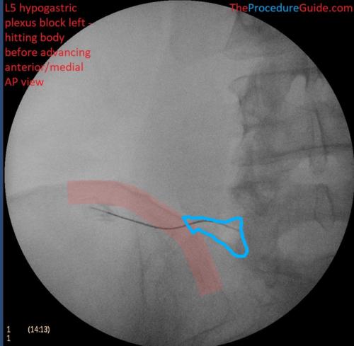 Hypogastric Plexus Block AP and Oblique fluoroscopy annotated borders