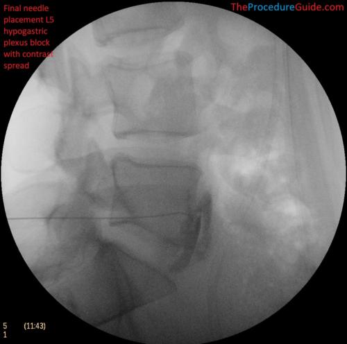 Hypogastric Plexus Block Lateral fluoroscopy with contrast