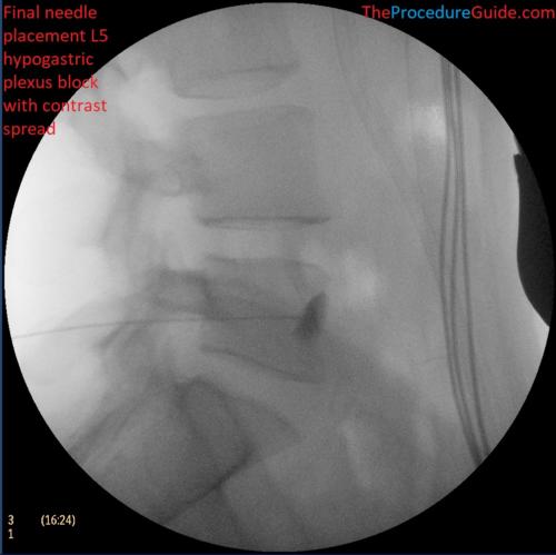 Hypogastric Plexus Block Lateral fluoroscopy with contrast