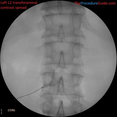 L2-transforaminal-epidural-steroid-injection-fluoroscopy-AP