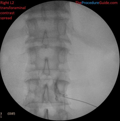 L2-transforaminal-epidural-steroid-injection-fluoroscopy-AP