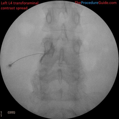 L4-transforaminal-epidural-steroid-injection-fluoroscopy-AP