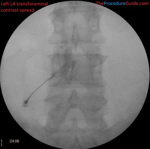 L4-transforaminal-epidural-steroid-injection-fluoroscopy-AP