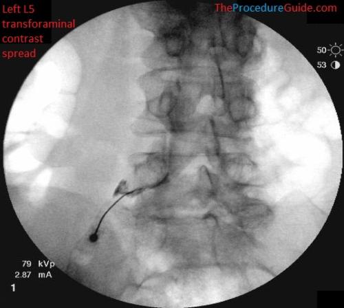 L5-transforaminal-epidural-steroid-injection-fluoroscopy-oblique