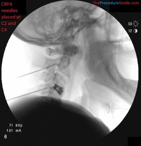 Lateral Fluoroscopy cervical radiofrequency ablation needle placement C2 and C4