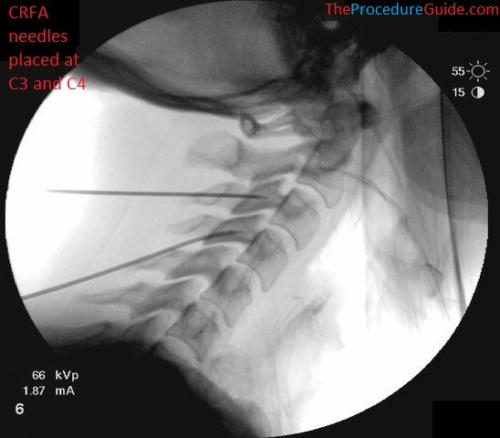 Lateral Fluoroscopy cervical radiofrequency ablation needle placement C3 and C4