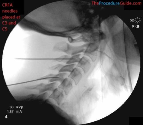 Lateral Fluoroscopy cervical radiofrequency ablation needle placement C3 and C5