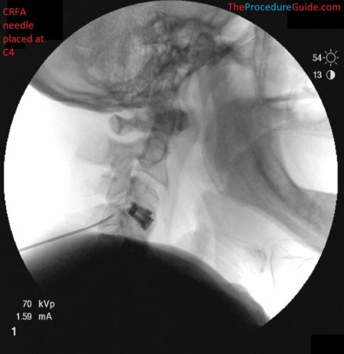 Lateral Fluoroscopy cervical radiofrequency ablation needle placement C4