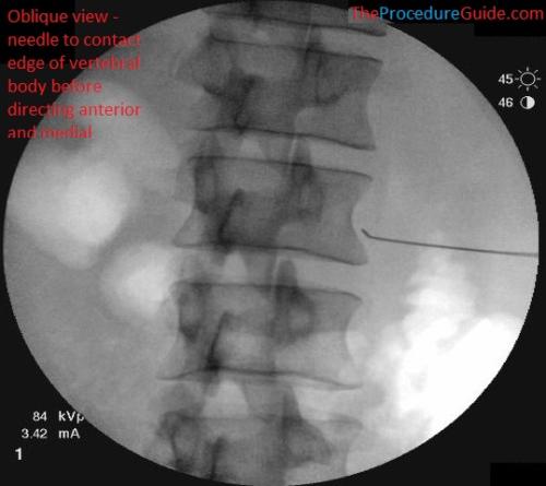 Oblique fluoroscopy lumbar sympathetic block