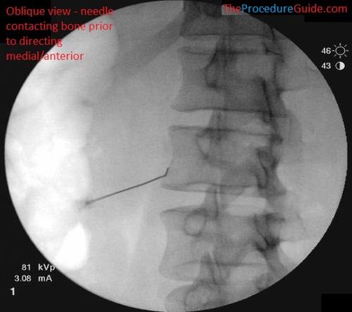 Oblique fluoroscopy lumbar sympathetic block