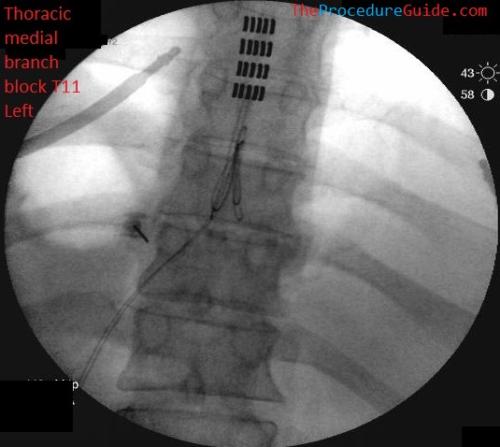 Thoracic Medial Branch Block AP fluoroscopy T11 Left