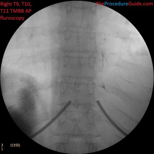 Thoracic Medial Branch Block AP fluoroscopy T9 T10 T10 Right