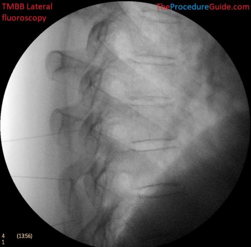 Thoracic Medial Branch Block Lateral fluoroscopy