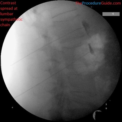 lateral fluoroscopy with contrast lumbar sympathetic block