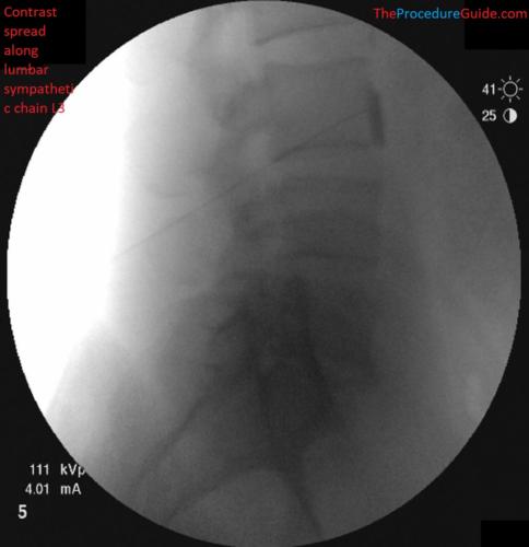 lateral fluoroscopy with contrast lumbar sympathetic block