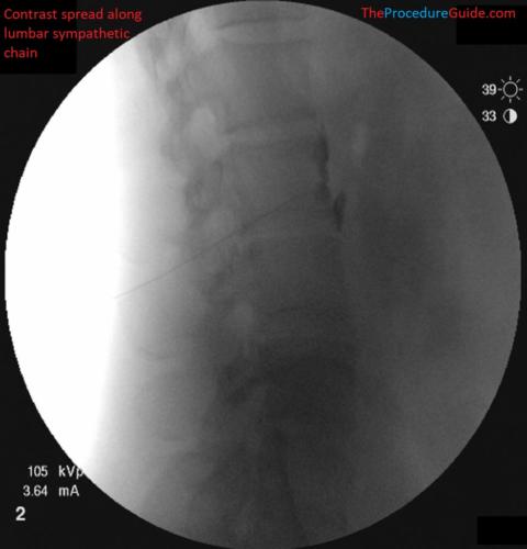 lateral fluoroscopy with contrast lumbar sympathetic block