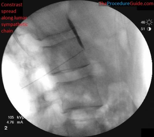 lateral fluoroscopy with contrast lumbar sympathetic block