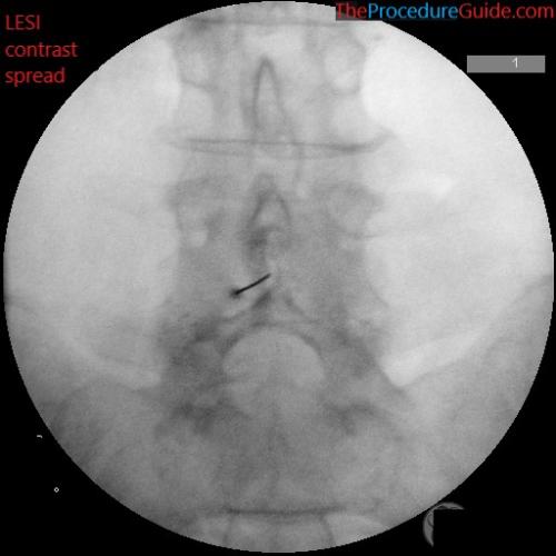 lumbar epidural steroid injection AP fluoroscopy contrast