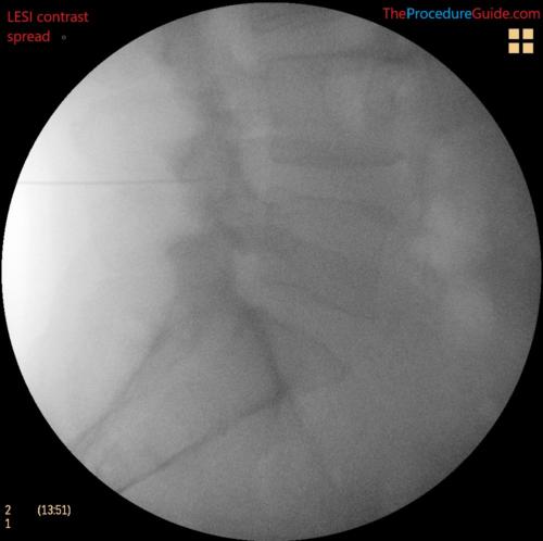 lumbar epidural steroid injection lateral fluoroscopy contrast