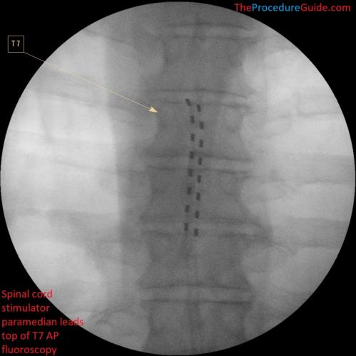 spinal cord stimulator trial lead AP fluoroscopy