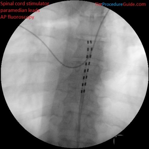 spinal cord stimulator trial leads AP fluoroscopy