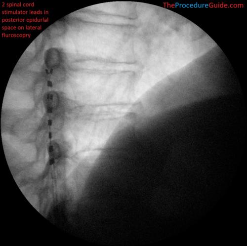 spinal cord stimulator trial leads fluoroscopy lateral