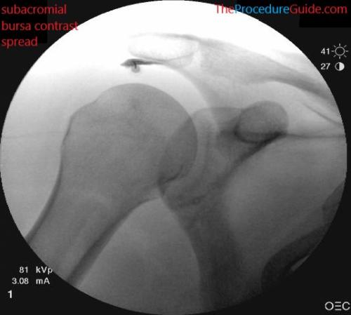 subacromial bursa injection fluoroscopy