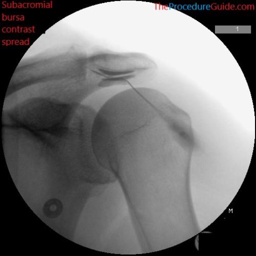 subacromial bursa injection fluoroscopy